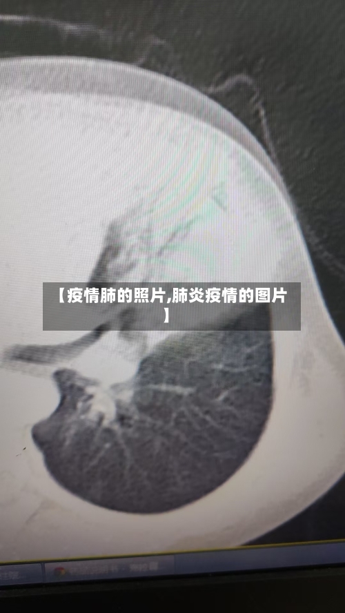 【疫情肺的照片,肺炎疫情的图片】