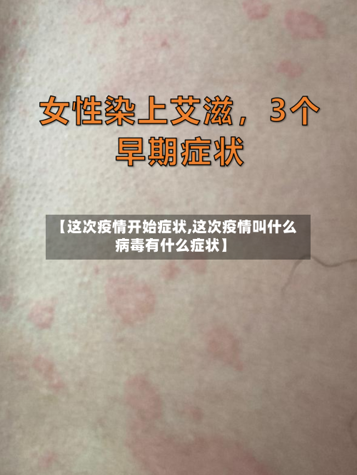 【这次疫情开始症状,这次疫情叫什么病毒有什么症状】-第3张图片