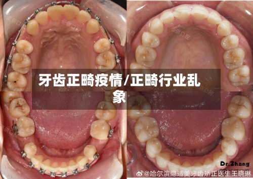 牙齿正畸疫情/正畸行业乱象-第2张图片