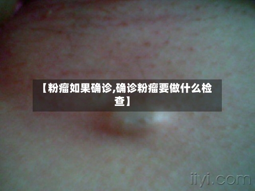 【粉瘤如果确诊,确诊粉瘤要做什么检查】