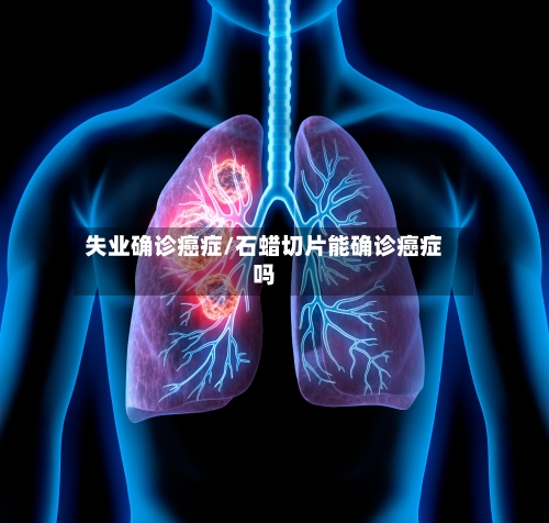 失业确诊癌症/石蜡切片能确诊癌症吗