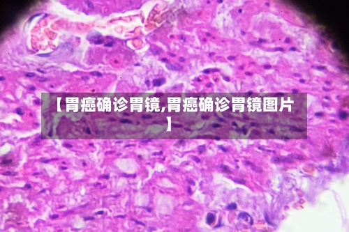【胃癌确诊胃镜,胃癌确诊胃镜图片】