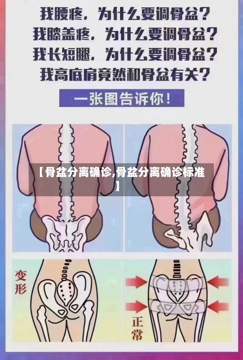 【骨盆分离确诊,骨盆分离确诊标准】-第2张图片